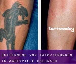 Entfernung von Tätowierungen in Abbeyville (Colorado)
