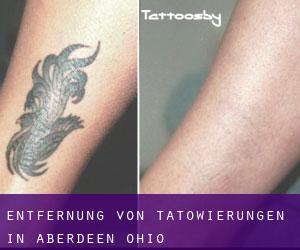 Entfernung von Tätowierungen in Aberdeen (Ohio)