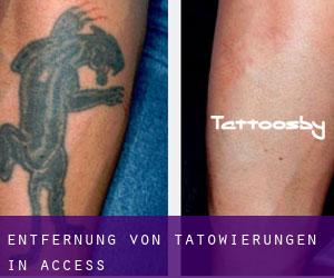 Entfernung von Tätowierungen in Access