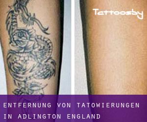 Entfernung von Tätowierungen in Adlington (England)