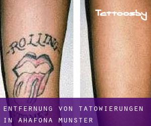 Entfernung von Tätowierungen in Ahafona (Munster)