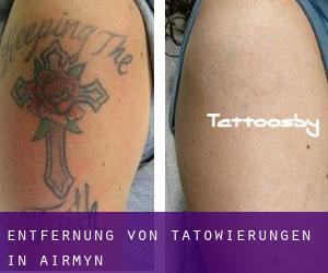 Entfernung von Tätowierungen in Airmyn