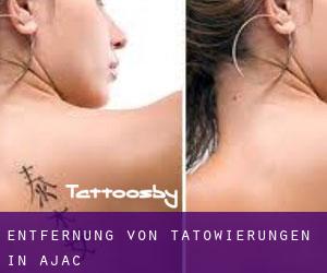 Entfernung von Tätowierungen in Ajac