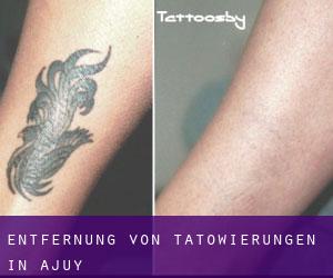 Entfernung von Tätowierungen in Ajuy