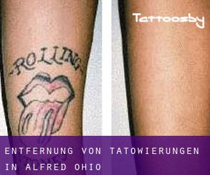 Entfernung von Tätowierungen in Alfred (Ohio)