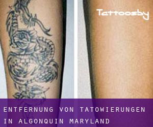 Entfernung von Tätowierungen in Algonquin (Maryland)