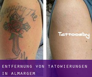 Entfernung von Tätowierungen in Almargem