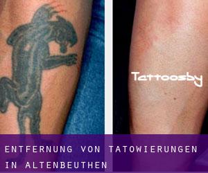 Entfernung von Tätowierungen in Altenbeuthen