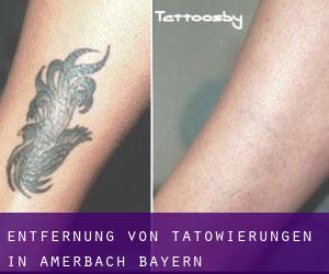 Entfernung von Tätowierungen in Amerbach (Bayern)