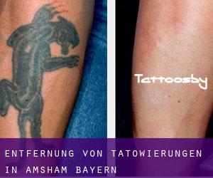 Entfernung von Tätowierungen in Amsham (Bayern)