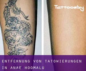 Entfernung von Tätowierungen in ‘Anae-ho‘omalu