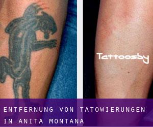 Entfernung von Tätowierungen in Anita (Montana)