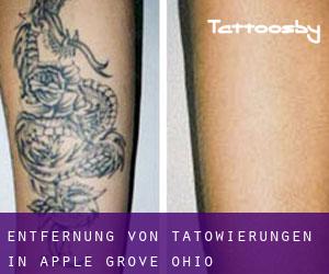 Entfernung von Tätowierungen in Apple Grove (Ohio)