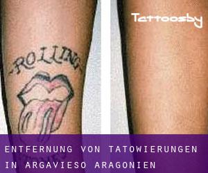 Entfernung von Tätowierungen in Argavieso (Aragonien)