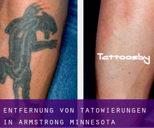 Entfernung von Tätowierungen in Armstrong (Minnesota)