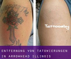 Entfernung von Tätowierungen in Arrowhead (Illinois)