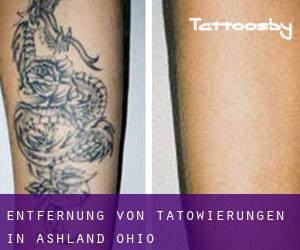 Entfernung von Tätowierungen in Ashland (Ohio)