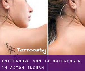 Entfernung von Tätowierungen in Aston Ingham