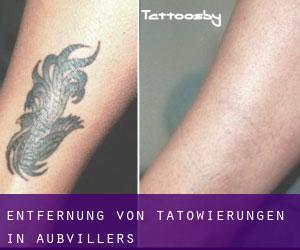 Entfernung von Tätowierungen in Aubvillers