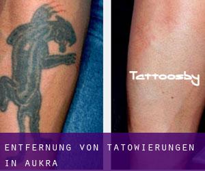 Entfernung von Tätowierungen in Aukra