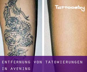 Entfernung von Tätowierungen in Avening