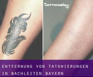 Entfernung von Tätowierungen in Bachleiten (Bayern)