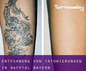 Entfernung von Tätowierungen in Bachtal (Bayern)
