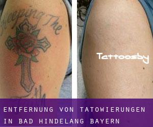 Entfernung von Tätowierungen in Bad Hindelang (Bayern)