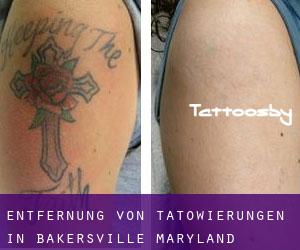 Entfernung von Tätowierungen in Bakersville (Maryland)