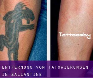 Entfernung von Tätowierungen in Ballantine