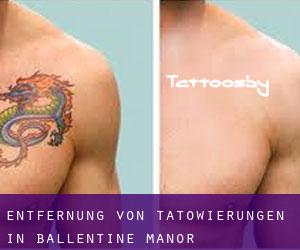 Entfernung von Tätowierungen in Ballentine Manor