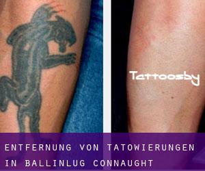 Entfernung von Tätowierungen in Ballinlug (Connaught)