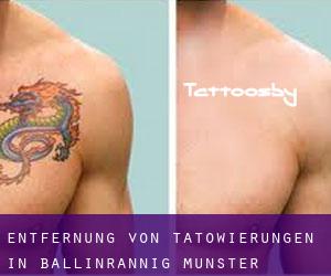 Entfernung von Tätowierungen in Ballinrannig (Munster)