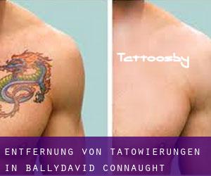 Entfernung von Tätowierungen in Ballydavid (Connaught)