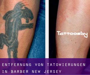 Entfernung von Tätowierungen in Barber (New Jersey)