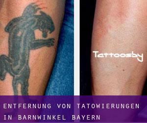 Entfernung von Tätowierungen in Bärnwinkel (Bayern)