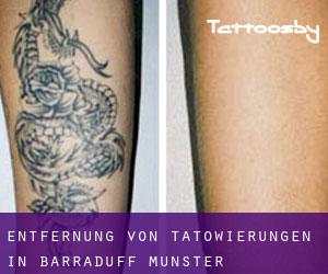 Entfernung von Tätowierungen in Barraduff (Munster)