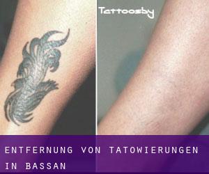 Entfernung von Tätowierungen in Bassan