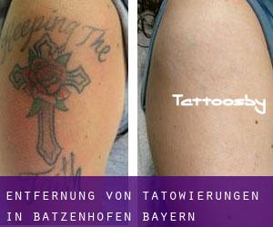 Entfernung von Tätowierungen in Batzenhofen (Bayern)
