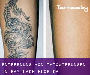 Entfernung von Tätowierungen in Bay Lake (Florida)