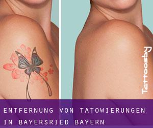 Entfernung von Tätowierungen in Bayersried (Bayern)