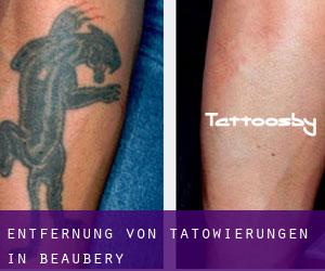 Entfernung von Tätowierungen in Beaubery