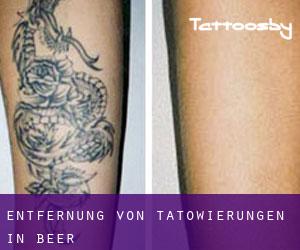 Entfernung von Tätowierungen in Beer