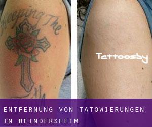 Entfernung von Tätowierungen in Beindersheim