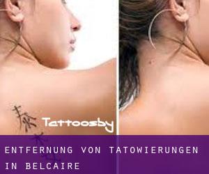 Entfernung von Tätowierungen in Belcaire