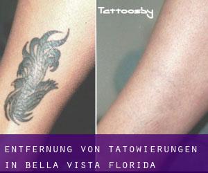 Entfernung von Tätowierungen in Bella Vista (Florida)