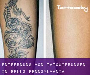 Entfernung von Tätowierungen in Bells (Pennsylvania)