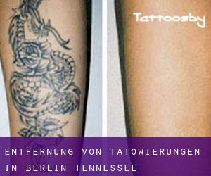 Entfernung von Tätowierungen in Berlin (Tennessee)