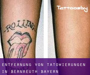 Entfernung von Tätowierungen in Bernreuth (Bayern)