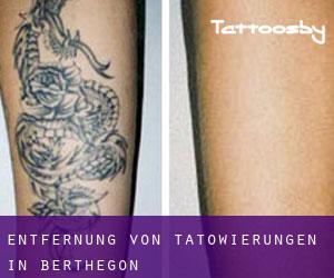 Entfernung von Tätowierungen in Berthegon